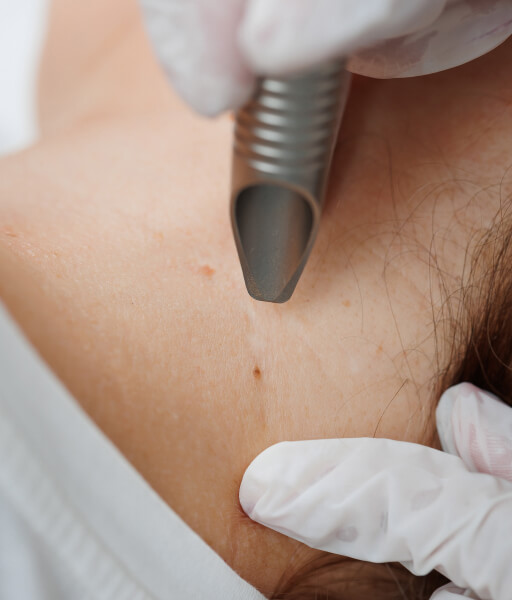 Бажаєш позбутися папілом?