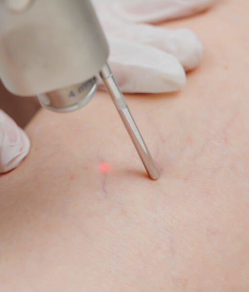 Видалення судинної сітки 