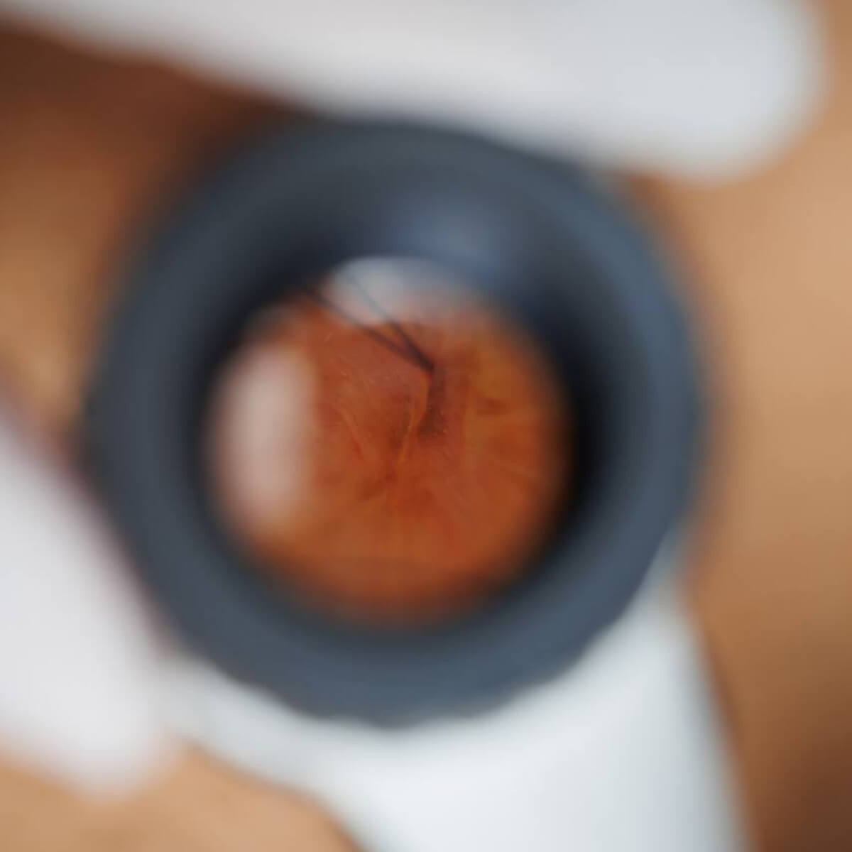 Дерматоскопія