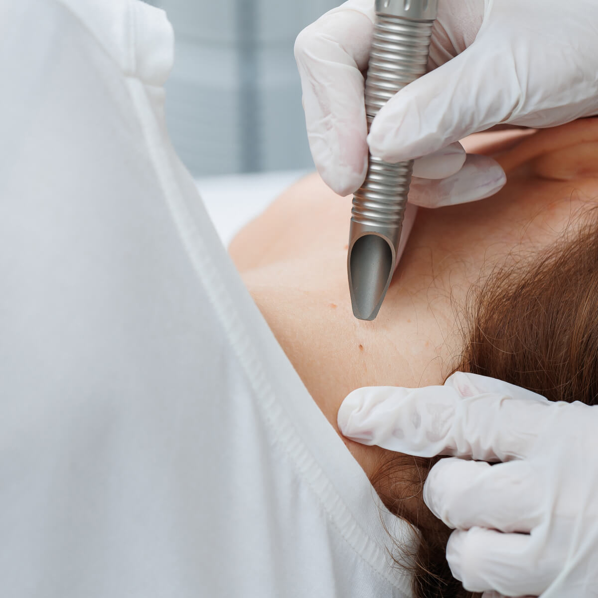 Лазерне видалення